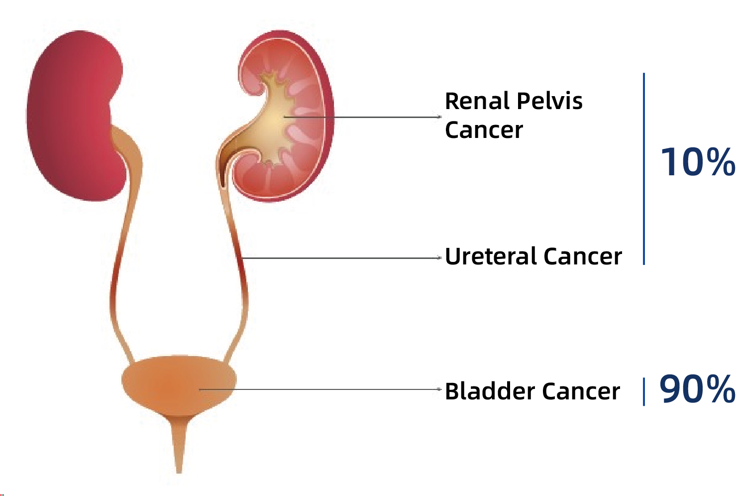 Urothelial Carcinoma (Urine Early Screening) 